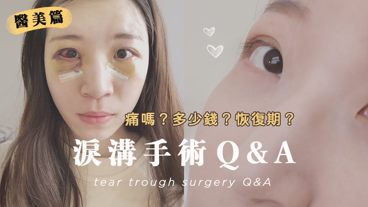 (不喜醫美慎入) 淚溝手術Q&A｜痛嗎？多少錢？影響視力？